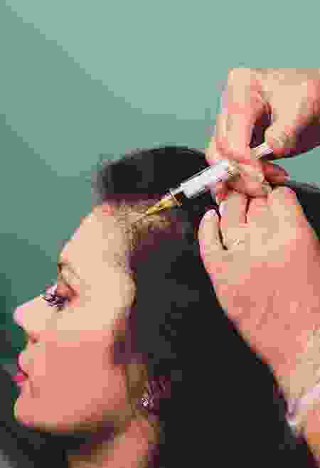 hair-transplant